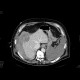 Hepatocellular carcinoma, ruptured, hemoperitoneum: CT - Computed tomography